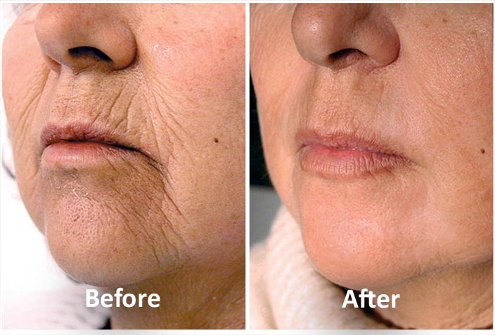 Skin Tightening Treatment - Croydon cosmetic clinic